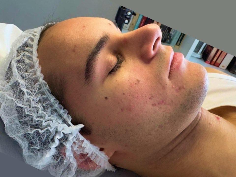 Efekt terapii kosmetologicznej po zabiegach w SkinCareWithMargo