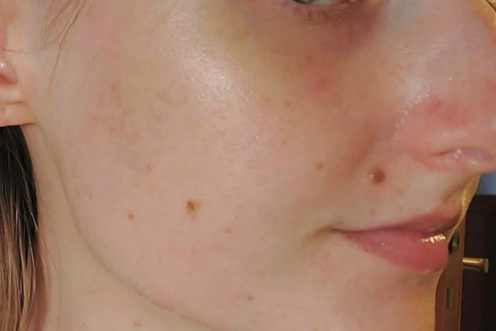 Efekt terapii kosmetologicznej po zabiegach w SkinCareWithMargo