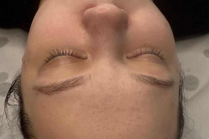 Efekt terapii kosmetologicznej po zabiegach w SkinCareWithMargo