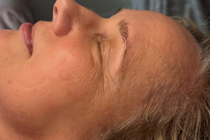 Efekt terapii kosmetologicznej po zabiegach w SkinCareWithMargo