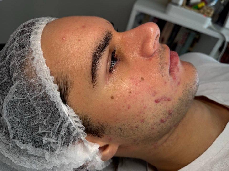 Stan skóry przed terapią kosmetologiczną w SkinCareWithMargo