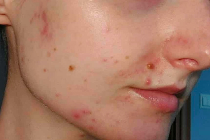 Stan skóry przed terapią kosmetologiczną w SkinCareWithMargo