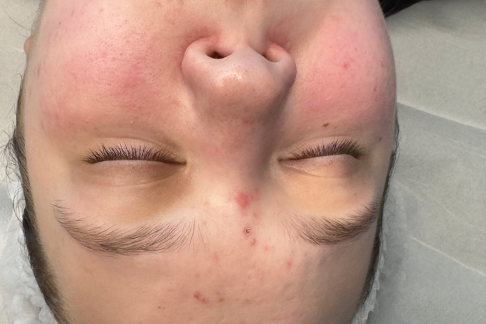 Stan skóry przed terapią kosmetologiczną w SkinCareWithMargo