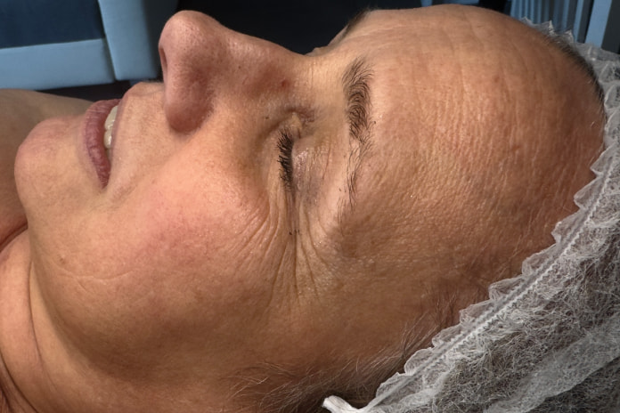 Stan skóry przed terapią kosmetologiczną w SkinCareWithMargo