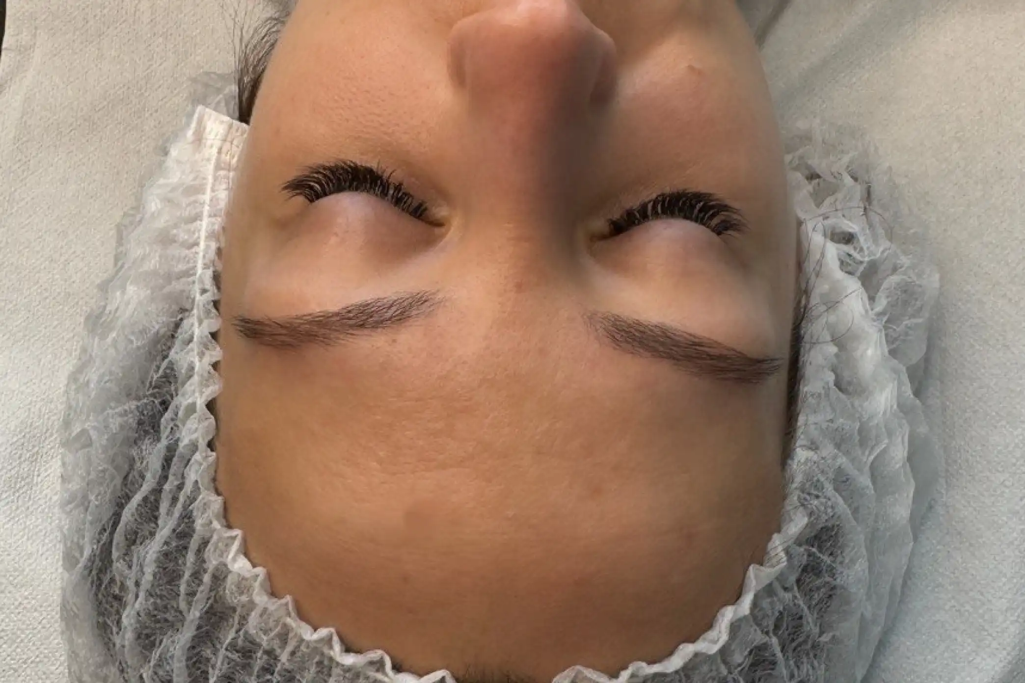 Efekt po serii zabiegów mezoterapii mikroigłowej w SkinCareWithMargo w Krakowie
