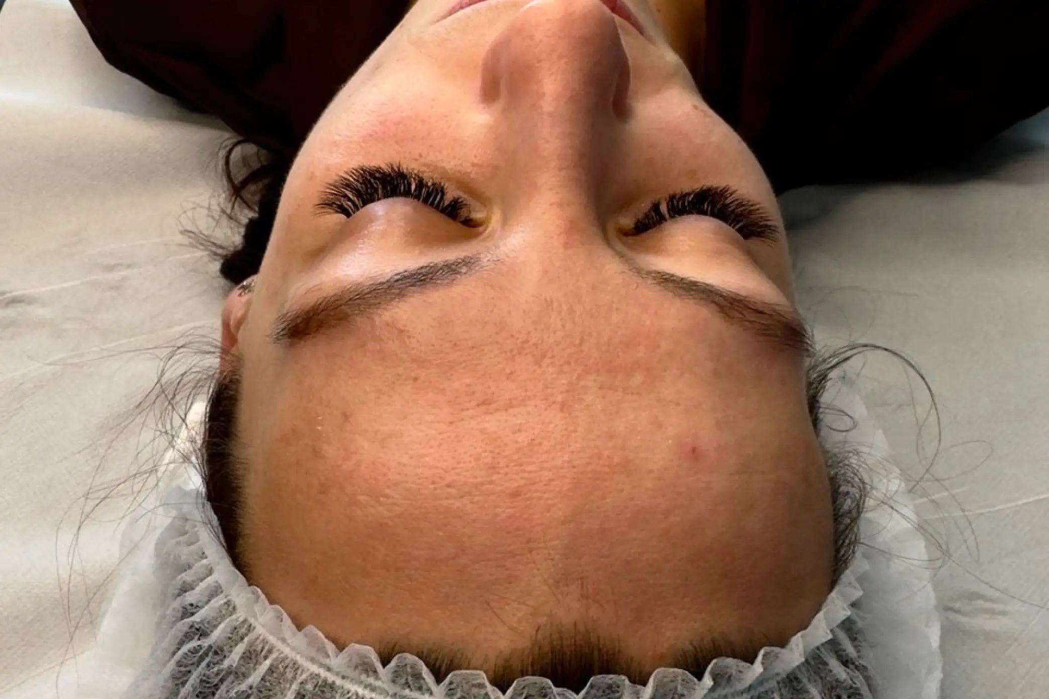 Skóra przed serią mezoterapii mikroigłowej w SkinCareWithMargo w Krakowie